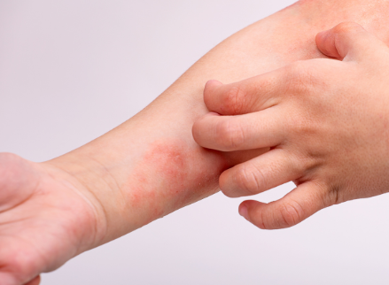 Atopic dermatitis: Everything you need to know!