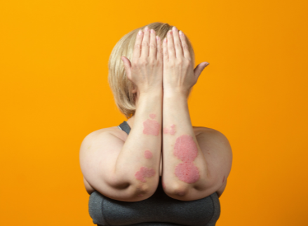 Psoriasis and self-esteem: Here’s how to feel more comfortable in your own skin