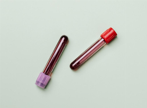 Blood tests: How to read and understand the results of a liver function test
