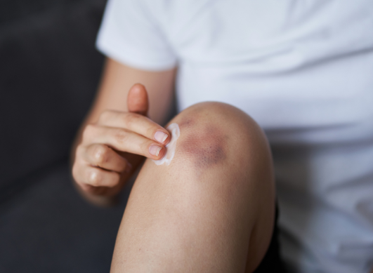 Why do some people bruise so easily?