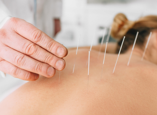 Acupuncture: how it works and when to use it